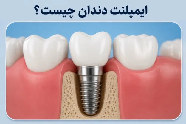 ایمپلنت دندان چیست