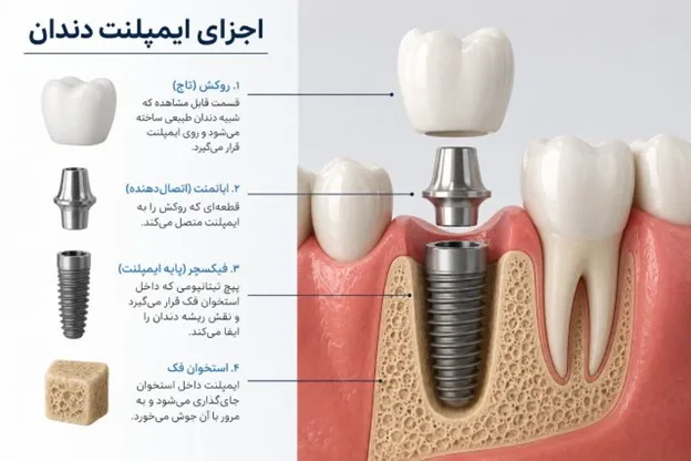 اجزای ایمپلنت دندان